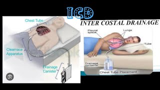 intercostal drainagerecurrent plueral effusionmbbsprocedure medicose Sudarshanlipane17 ⛑️⛑️🩺 [upl. by Aneehsar]