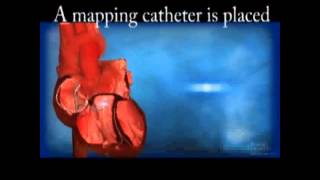 Ventricular Tachycardia VT Ablation [upl. by Ahsam]