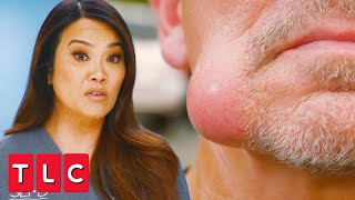 Squeezing Out a Swollen Jaw Lump  Dr Pimple Popper A Pimple Carol [upl. by Winn]