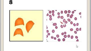 CLASE 2 ANORMALIDADES ERITROCITARIAS [upl. by Yllen]