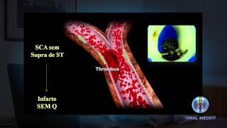 Infarto Agudo no Miocárdio  Fisiopatologia I 210 [upl. by Asirak620]