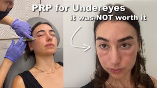 My Under Eye PRP Injection Journey Part 2 [upl. by Irafat207]