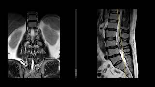 VERTEBRA TRANSICIONAL LUMBOSACRA EN RM  LUMBARIZACION DE S1 VS SACRALIZACION L5 [upl. by Atiken]