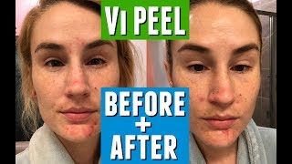 FIRST CHEMICAL PEEL WHAT TO EXPECT  Vi Peel Review Before  After [upl. by Raila]