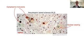 Structural insights into TDP43 pathology in ALS and FTD [upl. by Etteniuqna]