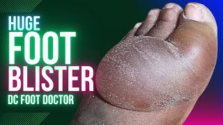 Enormous Foot Blister Diabetic Peripheral Neuropathy and Thermal Injury [upl. by Sowell828]