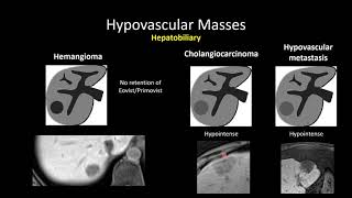 HypoVascular Masses of the Liver [upl. by Llenyr64]