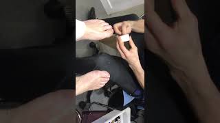 Video demonstrating how to redress the toe after ingrown nail surgery [upl. by Anayhd]