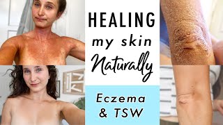 How I CURED Eczema amp Topical Steroid Withdrawal NATURALLY  My Skin Healing Journey [upl. by Animaj]