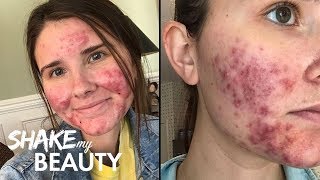 Going Out With My Severe Acne For The First Time  SHAKE MY BEAUTY [upl. by Perce]