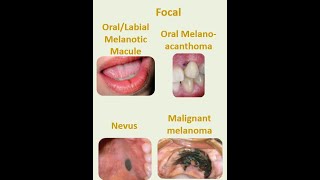 8 Focal melanosis [upl. by Justis]