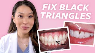 FIX Gaps in Teeth  How to Close Black Triangles [upl. by Rednaeel]