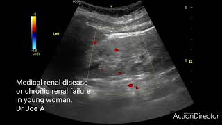 CRF or chronic renal failure or medical renal disease ultrasound video [upl. by Drape]