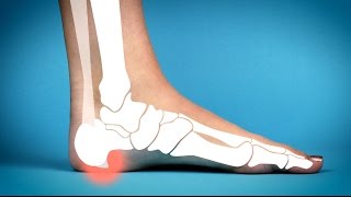 Two aids for heel spurs [upl. by Annel315]