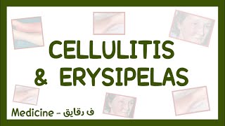 Cellulitis amp Erysipelas  clinical picture diagnosis amp treatment شرح عربي [upl. by Kizzie]