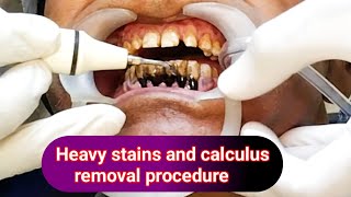 Heavy stains and calculus removal  Deep teeth cleaning treatment  drhirenpatelvlo [upl. by Sulienroc]