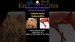 Systemic Lupus Erythematous  Sle systemiclupuserytgematous pathlink pathology [upl. by Aicilaanna]