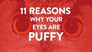 11 Reasons Why Your Eyes Are Puffy  Health [upl. by Aehsel]