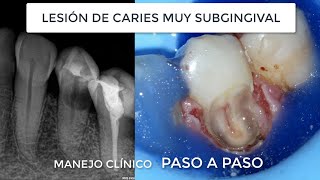 Empaste profundo caries radicular debajo de la encía y matar el nervio todo con aislamiento [upl. by Segalman]