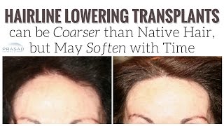 Why Transplanted Hair at the Hairline May Grow Thicker than Native Scalp Hair but Soften with Time [upl. by Killion]