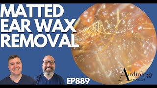 MATTED EAR WAX REMOVAL  EP889 [upl. by Imotih]