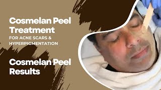 Cosmelan Peel Treatment for Acne Scars amp Hyperpigmentation  Cosmelan Peel Results  Beverly Hills [upl. by Michael]