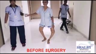 Witness the Power of Shalby’s quotZero Technique” Total Knee Replacement Surgery [upl. by Archibaldo]