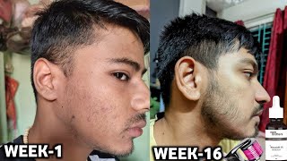 derma roller and minoxidil beard growth results  man matters beard oil review  beard growth tips [upl. by Loziram]