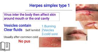 herpes simplex infection الهيربس [upl. by Vahe820]