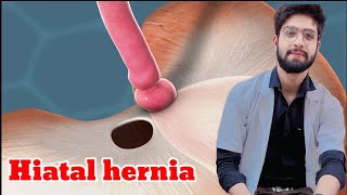 Hiatus hernia anatomy more [upl. by Neirb]