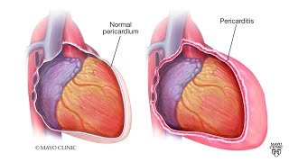 Mayo Clinic Minute What is pericarditis [upl. by Wurst]