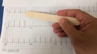 pericarditis on EKG [upl. by Leelahk97]