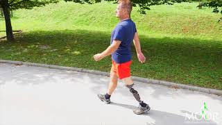 Amputee walking with microprocessor knee [upl. by Akiras]