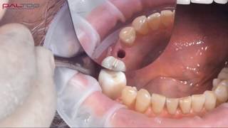 PALTOP Flapless Guided Implant Surgery using PAI  Dr Michael Klein [upl. by Mikey]