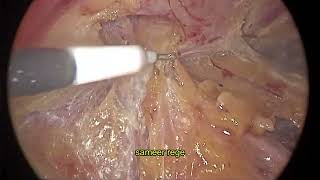 Laparoscopic Etep with Right TAR for recurrent ventral hernia [upl. by Yliah]