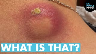 WHAT IS THAT Dr Lee Pops Satisfying Back Cyst  Dr Pimple Popper Reacts [upl. by Nevear]