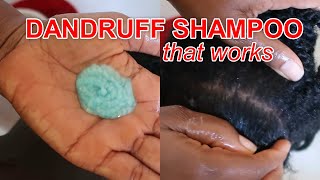 Best SHAMPOO for Dandruff  How to use Nizoral AntiDandruff Shampoo  Discoveringnatural [upl. by Vastah]