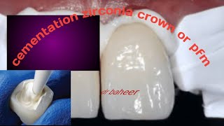 cementation to zirconia crown or pfm crown بالتفصيلdental crown [upl. by Kasevich322]