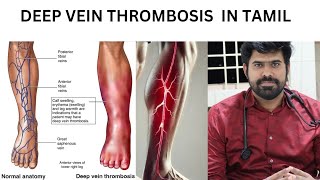 how to prevent DVT  Treatment for DVT  Doctor aditha cibi [upl. by Trbor297]