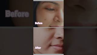 Acne marks treatmentacne marks home remediesshorts trending viralvideo ytshorts viralshorts [upl. by Nnaer466]