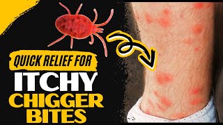 How to Treat Chigger Bites At Home [upl. by Cassius281]