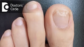 What causes white spots on toenails  Dr Aruna Prasad [upl. by Einnij304]