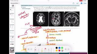 communicating and Normal pressure hydrocephalus neurology 102  First Aid USMLE Step 1 in hindi [upl. by Theresita837]