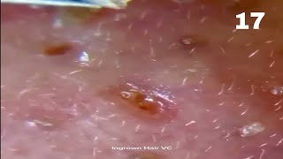 Nose Blackhead Removal Whiteheads On The Nose The Skin Is Dug Very Tightly Clip 17 [upl. by Enerak]