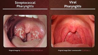 Streptococcal vs Viral Pharyngitis [upl. by Rizzi916]