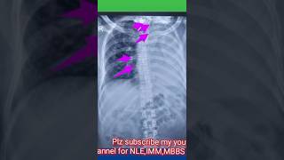 4 signs of lung collapse on chest xray  4 causes of lung collapse on chest xraychestxraymbbs [upl. by Emilia786]