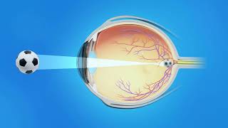 Nearsightedness Myopia [upl. by Rachelle]