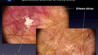 UERATOSIS ACTINICAS Y ENFERMEDAD DE BOWEN  Dr Renato Bakos [upl. by Minabe498]