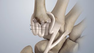 Osteoarthritis of the Thumb Surgical Treatment LRTI [upl. by Helprin781]