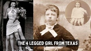 Four legged woman Josephine Myrtle Corbin that rocked the medical world [upl. by Stila]